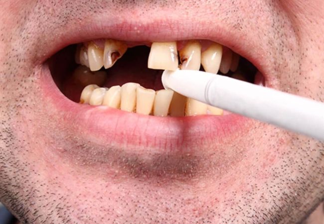 Implant