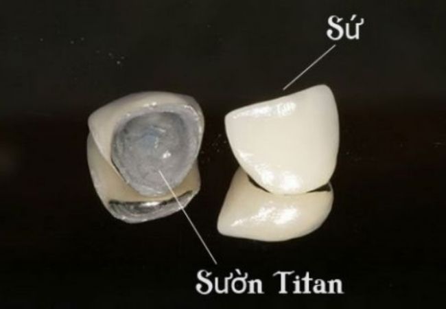 Implant
