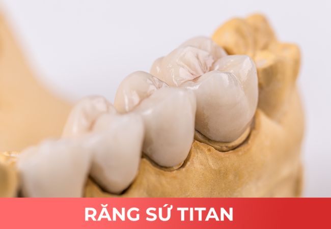 Implant