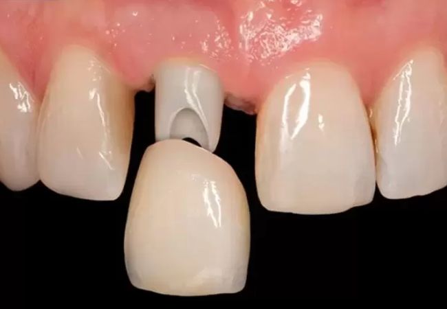 Implant