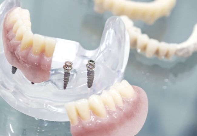 Implant