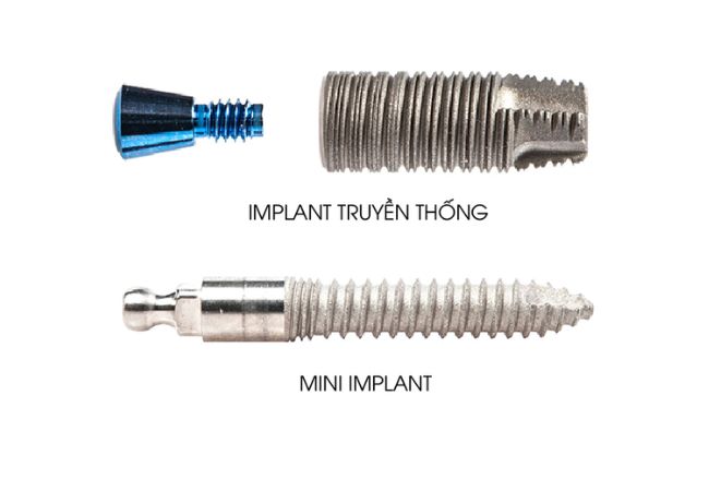 Implant