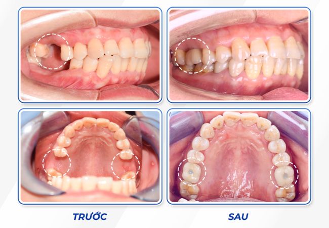 Implant