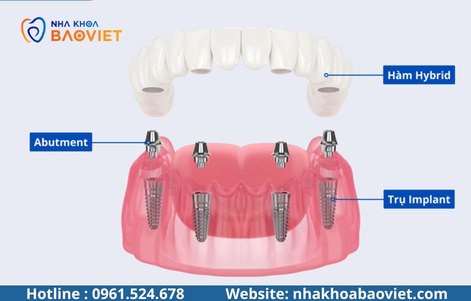 Trồng Implant răng hàm: Lực nhai và độ bền