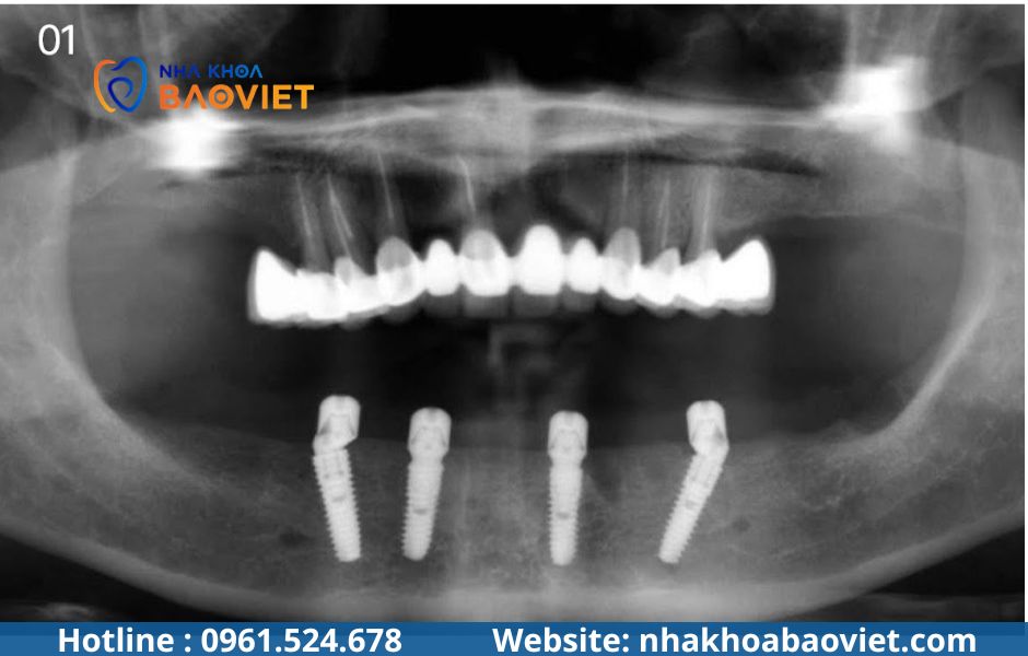 Implant
