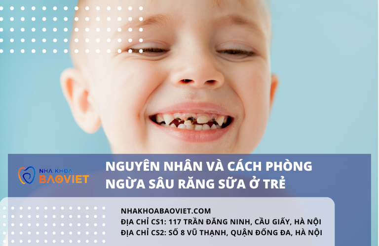Nguyên nhân và cách phòng ngừa sâu răng sữa ở trẻ