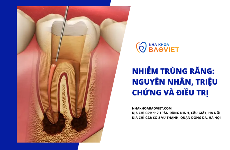 Nhiễm Trùng Răng: Nguyên Nhân, Triệu Chứng và Điều Trị