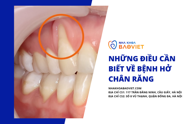 Những điều cần biết về bệnh hở chân răng