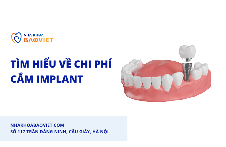 Tìm hiểu về chi phí cắm implant