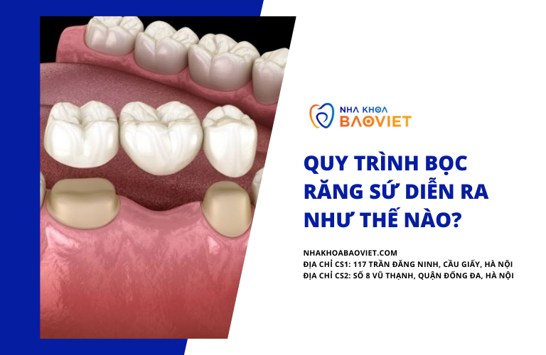 Quy trình bọc răng sứ diễn ra như thế nào?