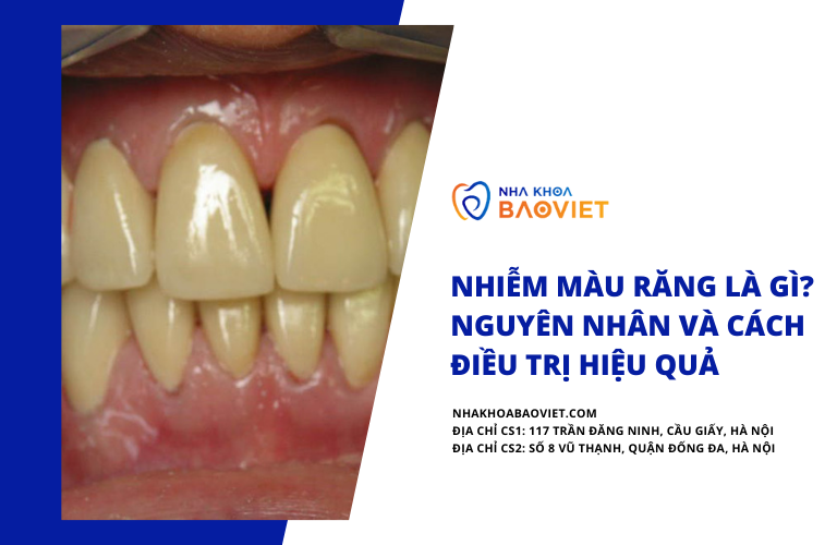 Nhiễm màu răng là gì? Nguyên nhân và cách điều trị hiệu quả