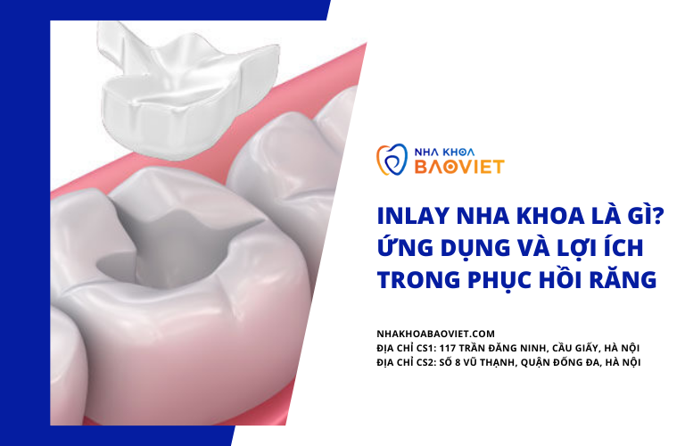 Inlay Nha Khoa Là Gì? Ứng Dụng và Lợi Ích Trong Phục Hồi Răng