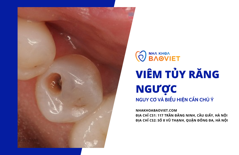 Viêm Tủy Răng Ngược: Nguy Cơ Và Biểu Hiện Cần Chú Ý