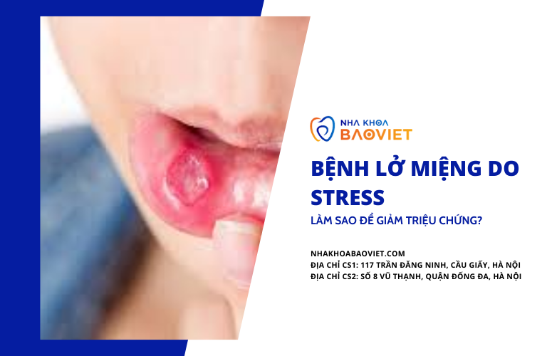 Bệnh Lở Miệng Do Stress: Làm Sao Để Giảm Triệu Chứng?