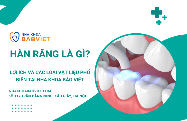Hàn Răng Là Gì? Lợi Ích Và Các Loại Vật Liệu Hàn Răng Phổ Biến Tại Nha Khoa Bảo Việt