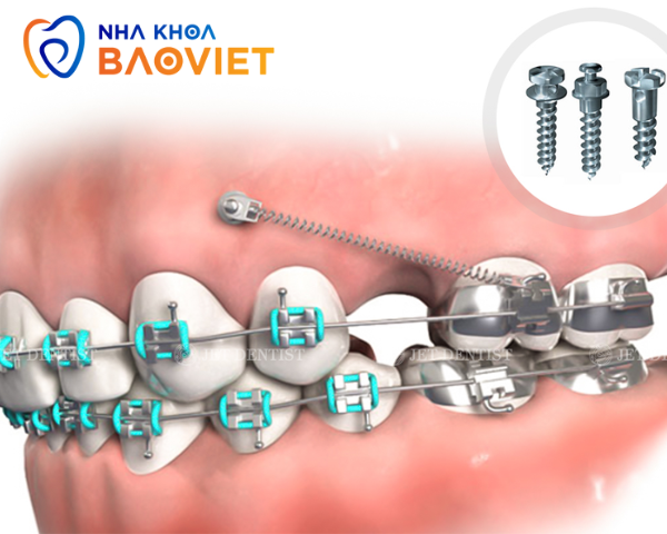 Niềng Răng Mắc Cài Kim Loại