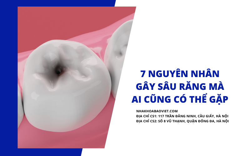 7 Nguyên Nhân Gây Sâu Răng Mà Ai Cũng Có Thể Gặp