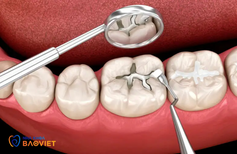 Hàn Răng Sâu: Quy Trình, Chi Phí Và Những Điều Cần Biết