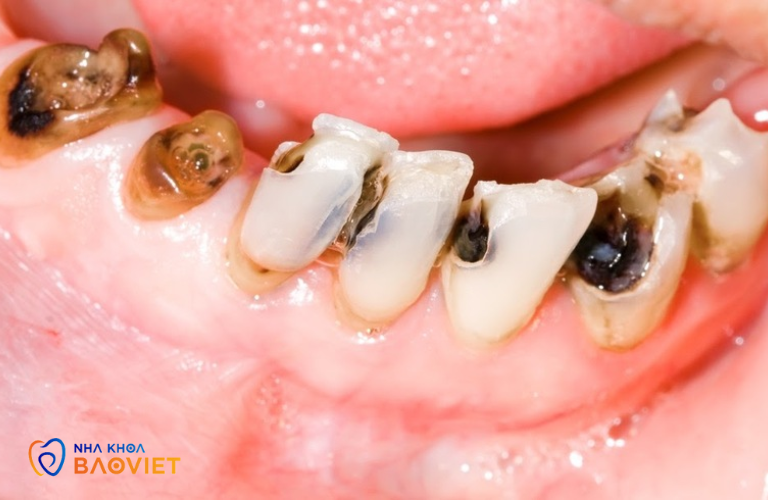 Sâu Răng Có Nguy Hiểm Không? Hậu Quả Nếu Không Điều Trị