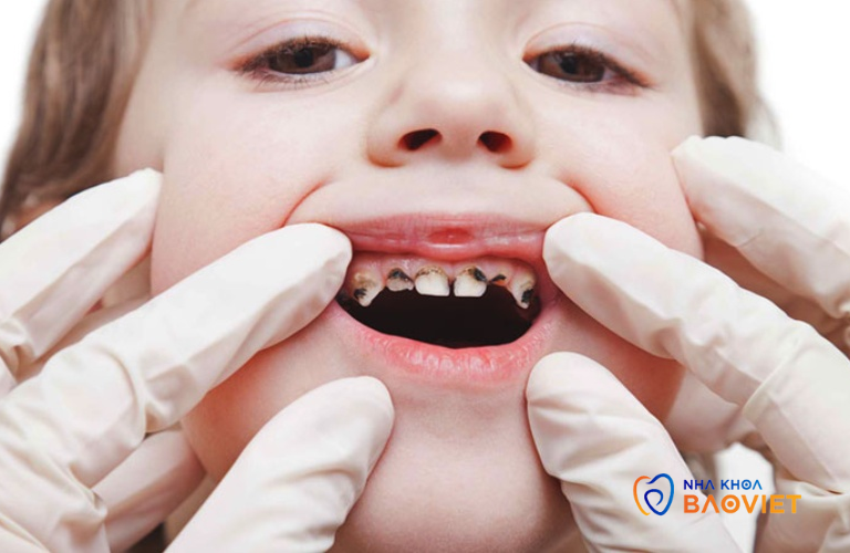 Sâu Răng Ở Trẻ Em: Cha Mẹ Cần Làm Gì Để Bảo Vệ Răng Của Con