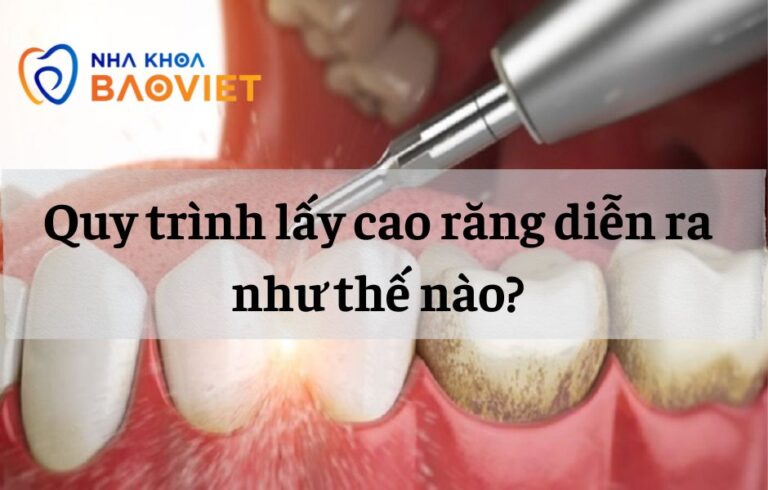 Quy trình lấy cao răng diễn ra như thế nào?