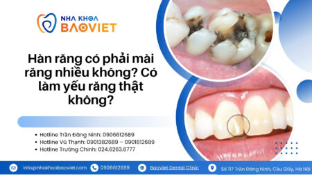 Hàn răng có phải mài răng nhiều không? Có làm yếu răng thật không?