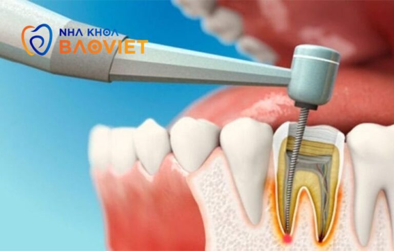 Sau điều trị tủy có cần bọc răng sứ không?