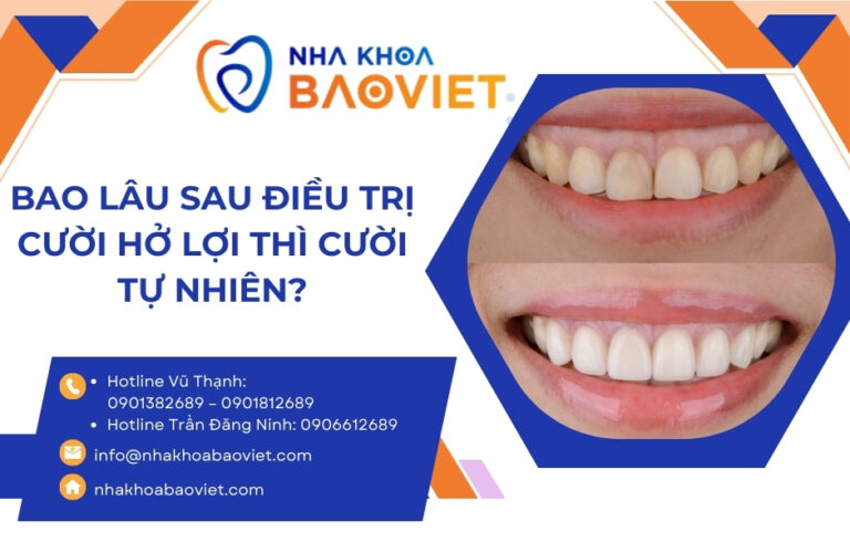 Bao lâu sau điều trị cười hở lợi thì cười tự nhiên?