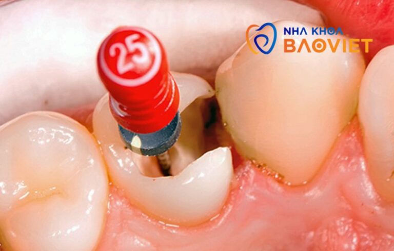 Răng sau điều trị tủy dùng được bao lâu?