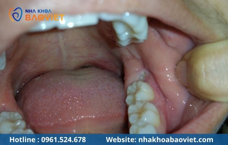 Răng số 8 là răng nào? Tại sao chuyên gia khuyên nên nhổ bỏ sớm?
