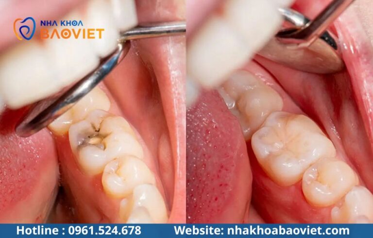 Răng số 8 bị sâu vỡ chỉ còn chân răng: Xử lý thế nào để không sưng viêm?