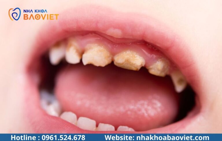 Trẻ Em Có Nên Lấy Cao Răng Không? Độ Tuổi Phù Hợp Nhất