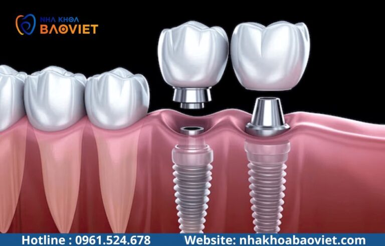 Implant hay cầu răng sứ: Nên chọn phương pháp nào?