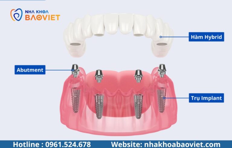 Trồng Implant răng hàm: Lực nhai và độ bền