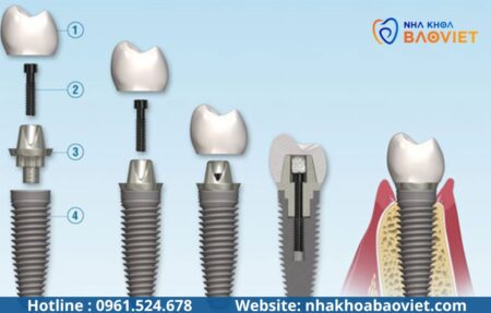 Nhổ răng xong bao lâu thì trồng Implant được? Bác sĩ giải đáp