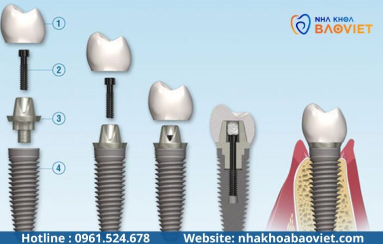 Nhổ răng xong bao lâu thì trồng Implant được? Bác sĩ giải đáp