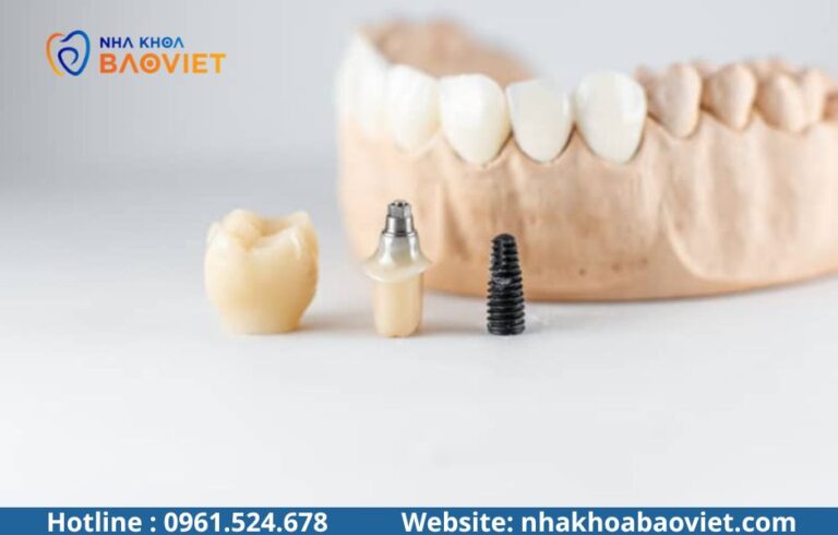 Chọn trụ Implant: Nên dựa vào những tiêu chí nào?