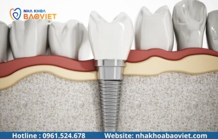 Implant 1 giai đoạn và 2 giai đoạn khác nhau ra sao? So sánh chi tiết