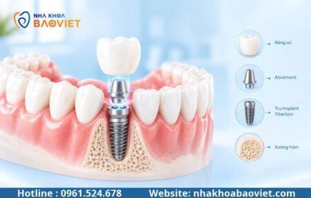 Trồng răng Implant ở đâu tốt tại Hà Nội? Tiêu chí chọn nha khoa uy tín