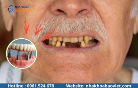 Người cao tuổi có trồng Implant được không? Điều kiện và những lưu ý cần biết