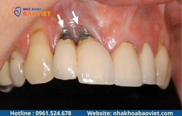 Bị viêm nha chu có trồng Implant được không? Những điều cần biết