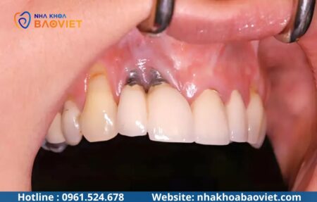 Viêm quanh Implant: Dấu hiệu nhận biết và cách điều trị hiệu quả