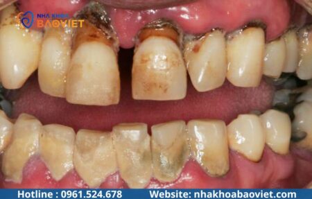 Hút thuốc lá ảnh hưởng thế nào đến trồng Implant?