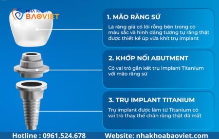 Trụ Implant các hãng khác nhau ở điểm nào? So sánh chi tiết từ A–Z