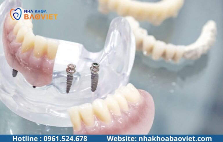 Mini Implant là gì? Khác gì Implant tiêu chuẩn?