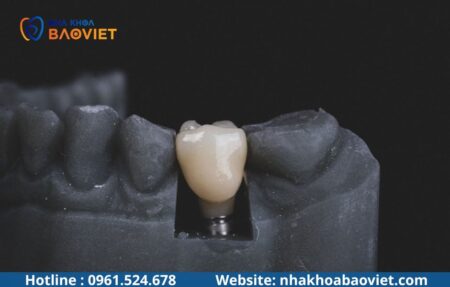 Mất Nhiều Răng Liên Tiếp: Nên Trồng Implant Thế Nào?