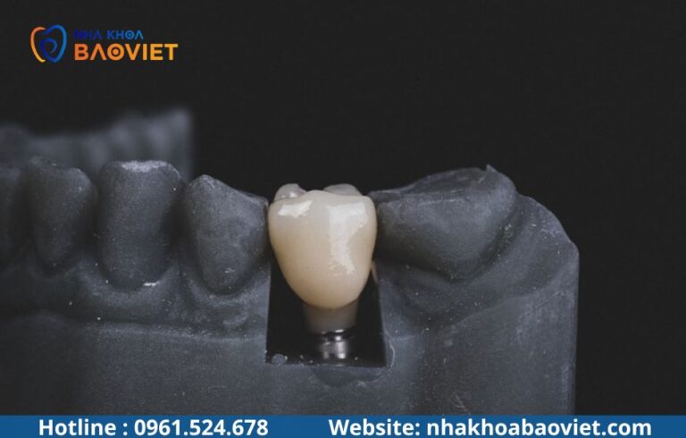 Mất Nhiều Răng Liên Tiếp: Nên Trồng Implant Thế Nào?